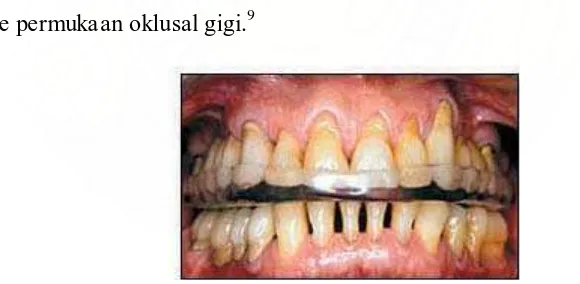 Manajemen Gigi Mobiliti Akibat Penyakit Periodontal