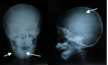 Penatalaksanaan fraktur pada anak dengan kepala | Hadira | MKGK (Majalah Kedokteran Gigi Klinik) (Clinical Dental Journal) UGM 28777 64743 1 SM
